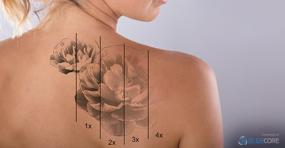 Tattoo Removal  Dermatology and Laser Centre of Los Angeles