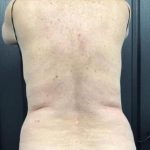 CoolSculpting Before & After Patient #5305