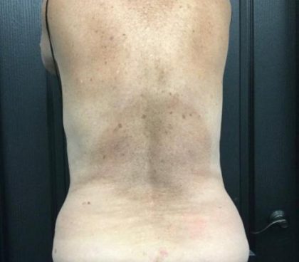 CoolSculpting Before & After Patient #5305