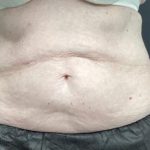 CoolSculpting Before & After Patient #5308