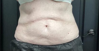 CoolSculpting Before & After Patient #5308