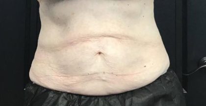 CoolSculpting Before & After Patient #5308