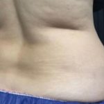 CoolSculpting Before & After Patient #5309