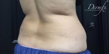 CoolSculpting Before & After Patient #5309