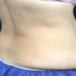 CoolSculpting Before & After Patient #5309