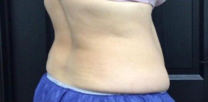 CoolSculpting Before & After Patient #5309