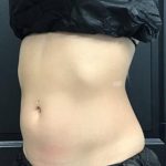 CoolSculpting Before & After Patient #5306