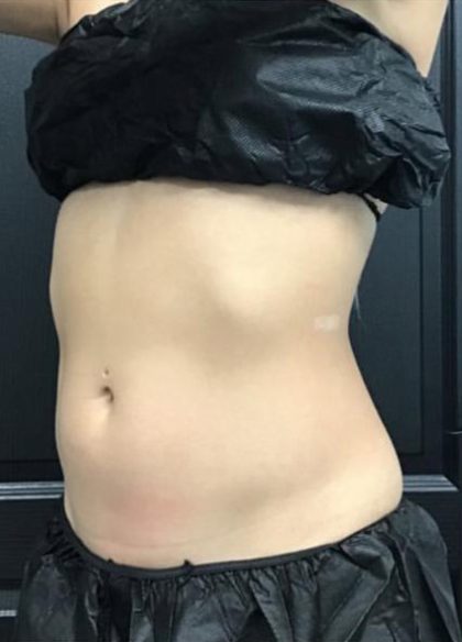 CoolSculpting Before & After Patient #5306