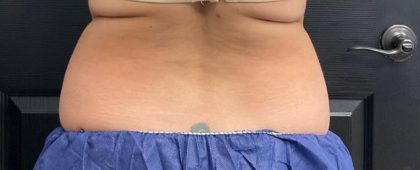 CoolSculpting Before & After Patient #5307