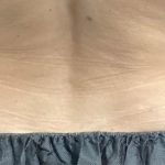 CoolSculpting Before & After Patient #5307