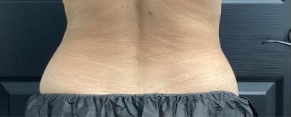 CoolSculpting Before & After Patient #5307