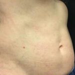 CoolSculpting Before & After Patient #5310