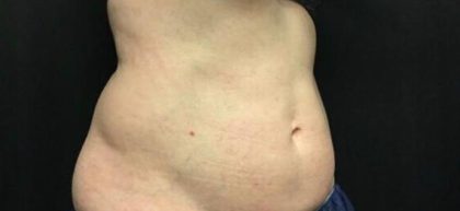 CoolSculpting Before & After Patient #5310