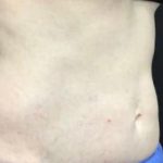 CoolSculpting Before & After Patient #5310