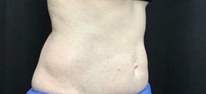 CoolSculpting Before & After Patient #5310