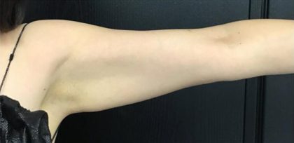 CoolSculpting Before & After Patient #5311