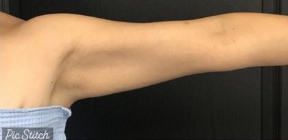 CoolSculpting Before & After Patient #5311