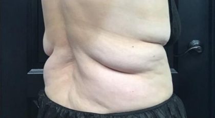 CoolSculpting Before & After Patient #5312