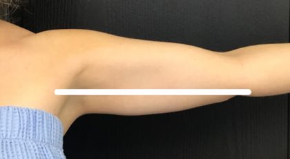 CoolSculpting Before & After Patient #5314