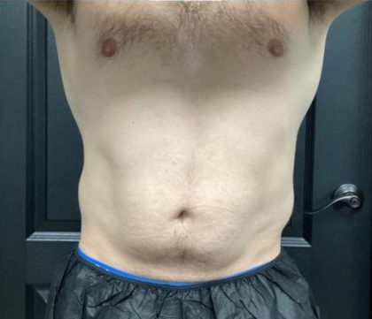 CoolSculpting Before & After Patient #5313