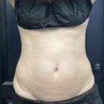 CoolSculpting Before & After Patient #5315