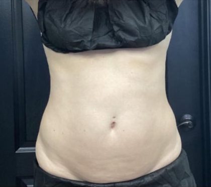 CoolSculpting Before & After Patient #5315