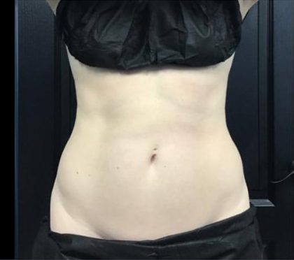 CoolSculpting Before & After Patient #5315