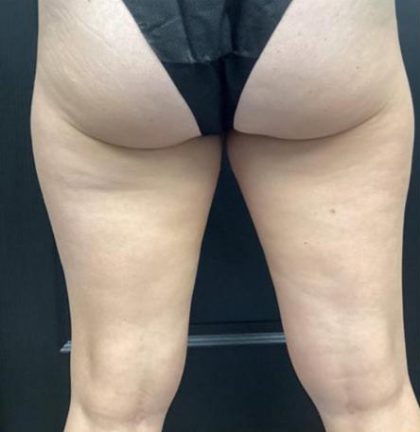 CoolSculpting Before & After Patient #5317