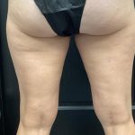 CoolSculpting Before & After Patient #5317