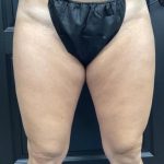 CoolSculpting Before & After Patient #5302