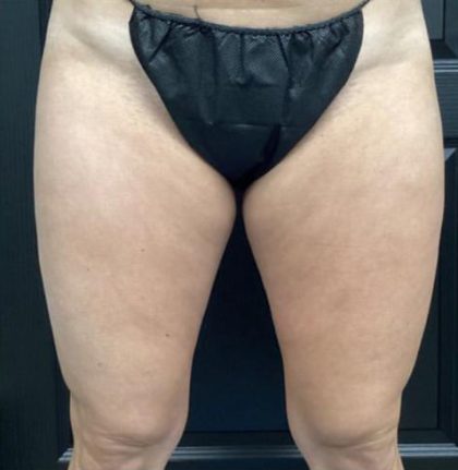 CoolSculpting Before & After Patient #5302