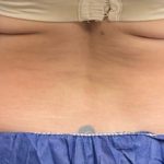 CoolSculpting Before & After Patient #5300