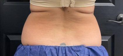 CoolSculpting Before & After Patient #5300