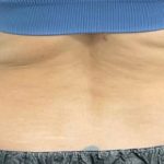 CoolSculpting Before & After Patient #5300