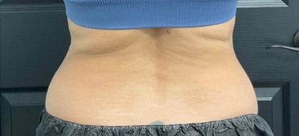 CoolSculpting Before & After Patient #5300