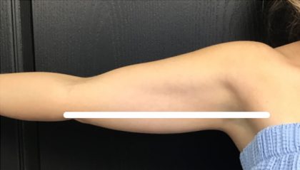 CoolSculpting Before & After Patient #5301