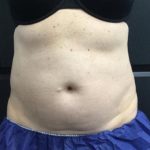 CoolSculpting Before & After Patient #5299