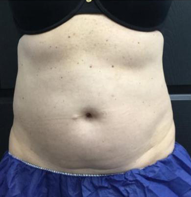 CoolSculpting Before & After Patient #5299