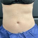 CoolSculpting Before & After Patient #5299