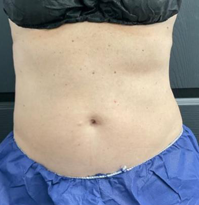 CoolSculpting Before & After Patient #5299