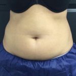 CoolSculpting Before & After Patient #5304