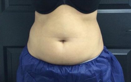 CoolSculpting Before & After Patient #5304