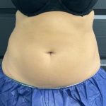 CoolSculpting Before & After Patient #5304