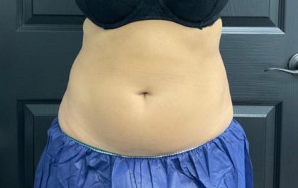 CoolSculpting Before & After Patient #5304