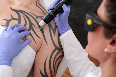 Tattoo Removal DermFx